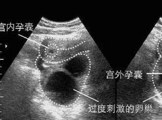 做试管婴儿女方很痛苦吗？危害会不会很大？